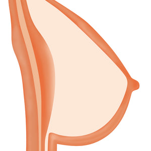 Solid Breast