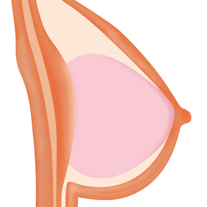 Gel Breast